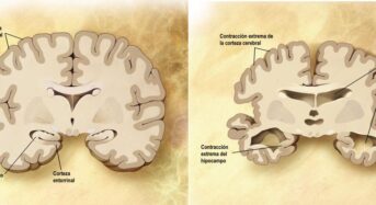 Amerikai betegek Kubában kezelik az Alzheimer-kórt